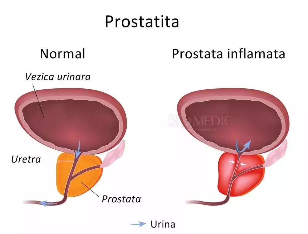 Reduceți Simptomele Și Îmbunătățiți Funcția Prostatei