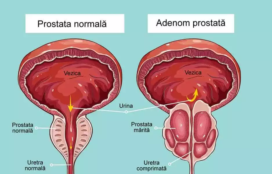 Prostasen cumpara Bacau – reducerea adenomului de prostata