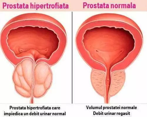 Prostasen În Bacău: Tratamentul Eficient Pentru Problemele Prostatei 