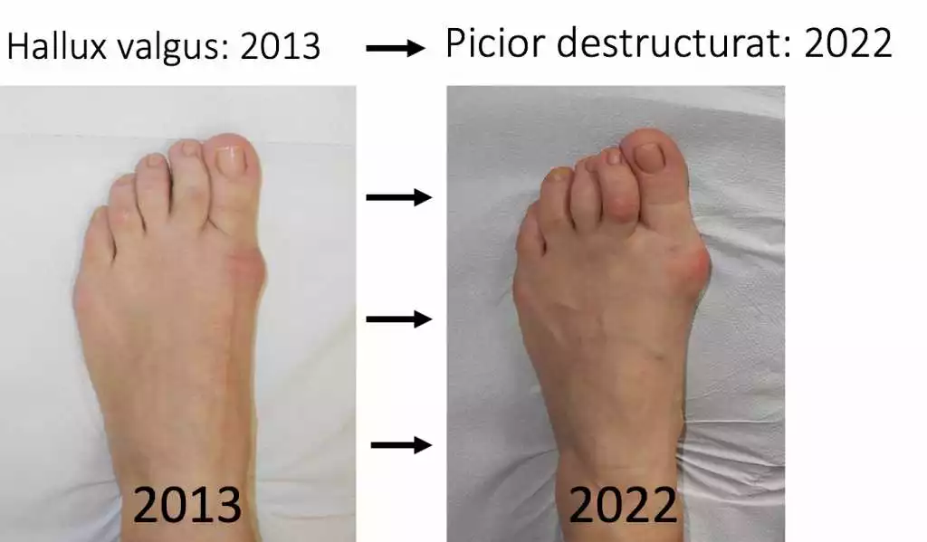 Valgus 2 in 1 în România – tratamentul sigur și eficient pentru deformarea valgus la nivelul piciorului