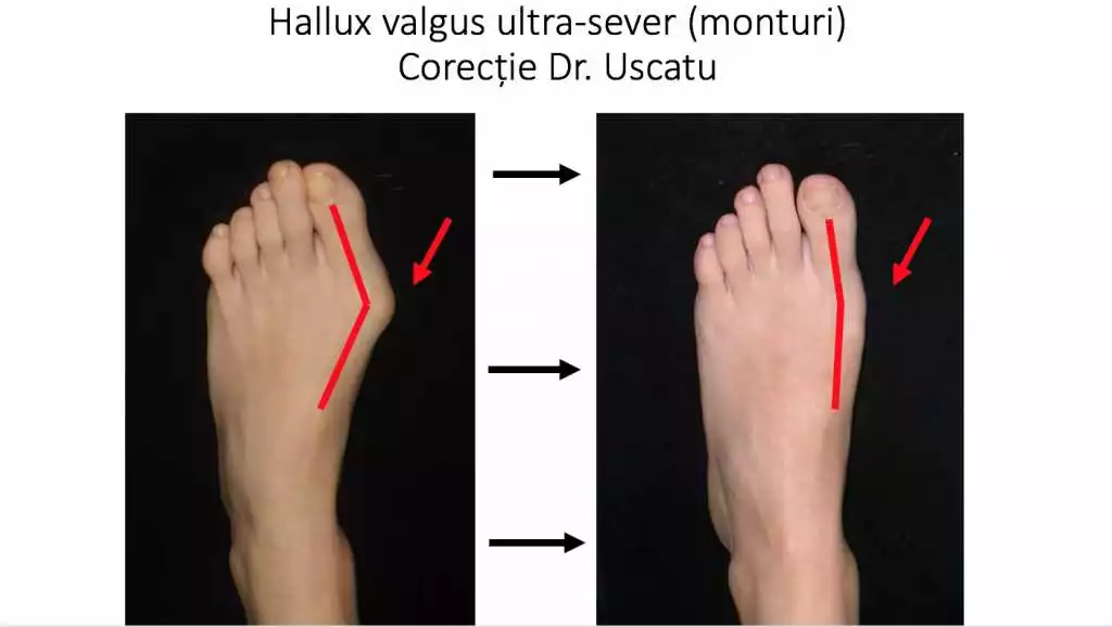Valgus 2 in 1 în Suceava: soluția eficientă împotriva deformatării piciorului